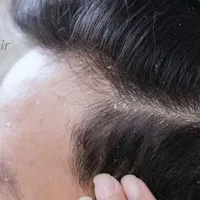 درمان‌های خانگی سریع برای شوره سر