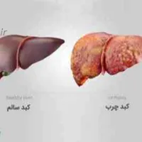 درمان کبد چرب چیست؟ ۵ روش خانگی از بین بردن چربی کبد